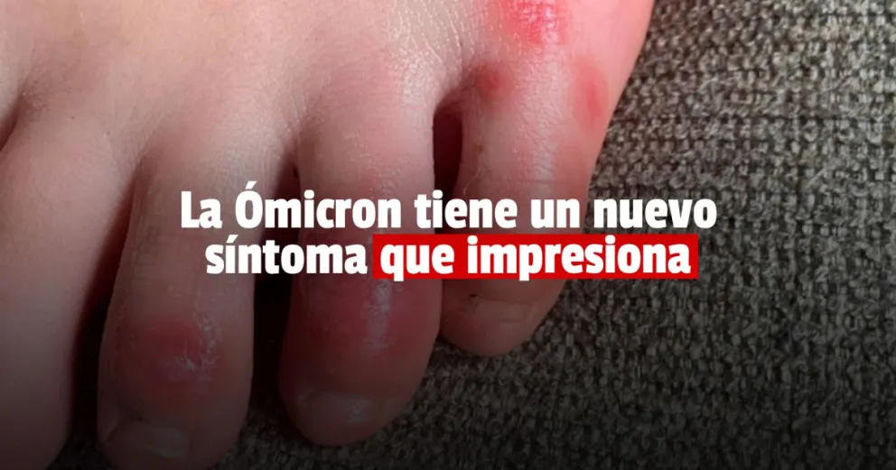 “Dedos de los pies COVID”, el nuevo síntoma detectado en pacientes infectados con Ómicron
